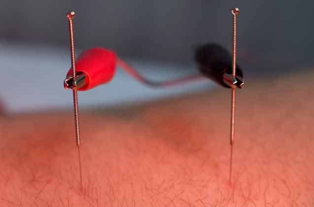 Elektroakupunktur adalah teknik yang menggabungkan akupunktur tradisional dengan stimulasi listrik. Dalam prosedur ini, jarum akupunktur yang telah dimasukkan ke titik-titik akupunktur pada tubuh dihubungkan dengan perangkat elektro yang menghasilkan arus listrik ringan. 