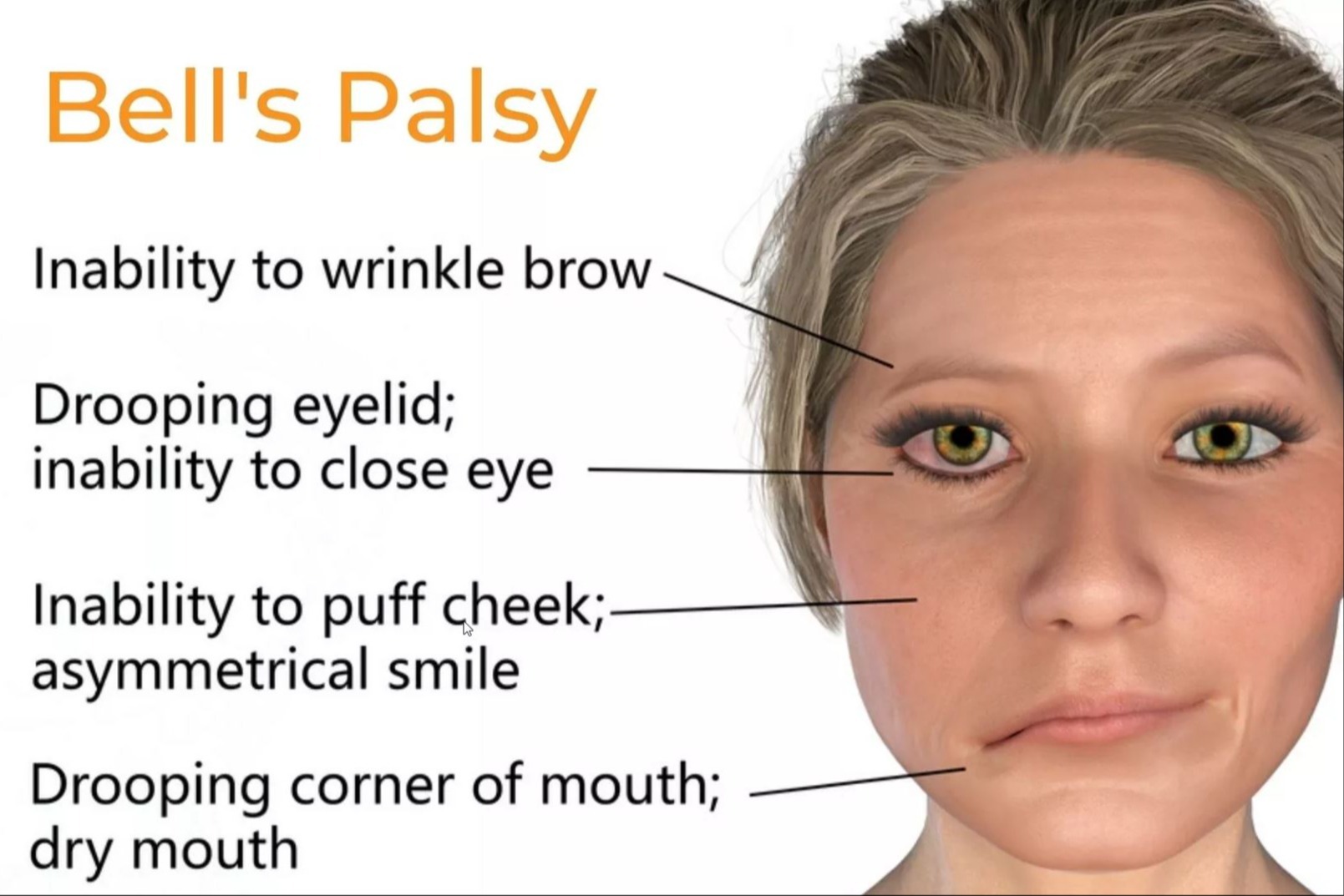 Cara Penanganan Pasien Bell's Palsy dengan Akupunktur